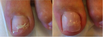Teennagel voor en na een nagelreparatie